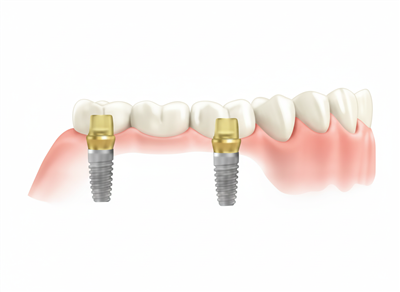 複数欠損のインプラント治療