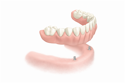 インプラントで固定する入れ歯（オーバーデンチャー）