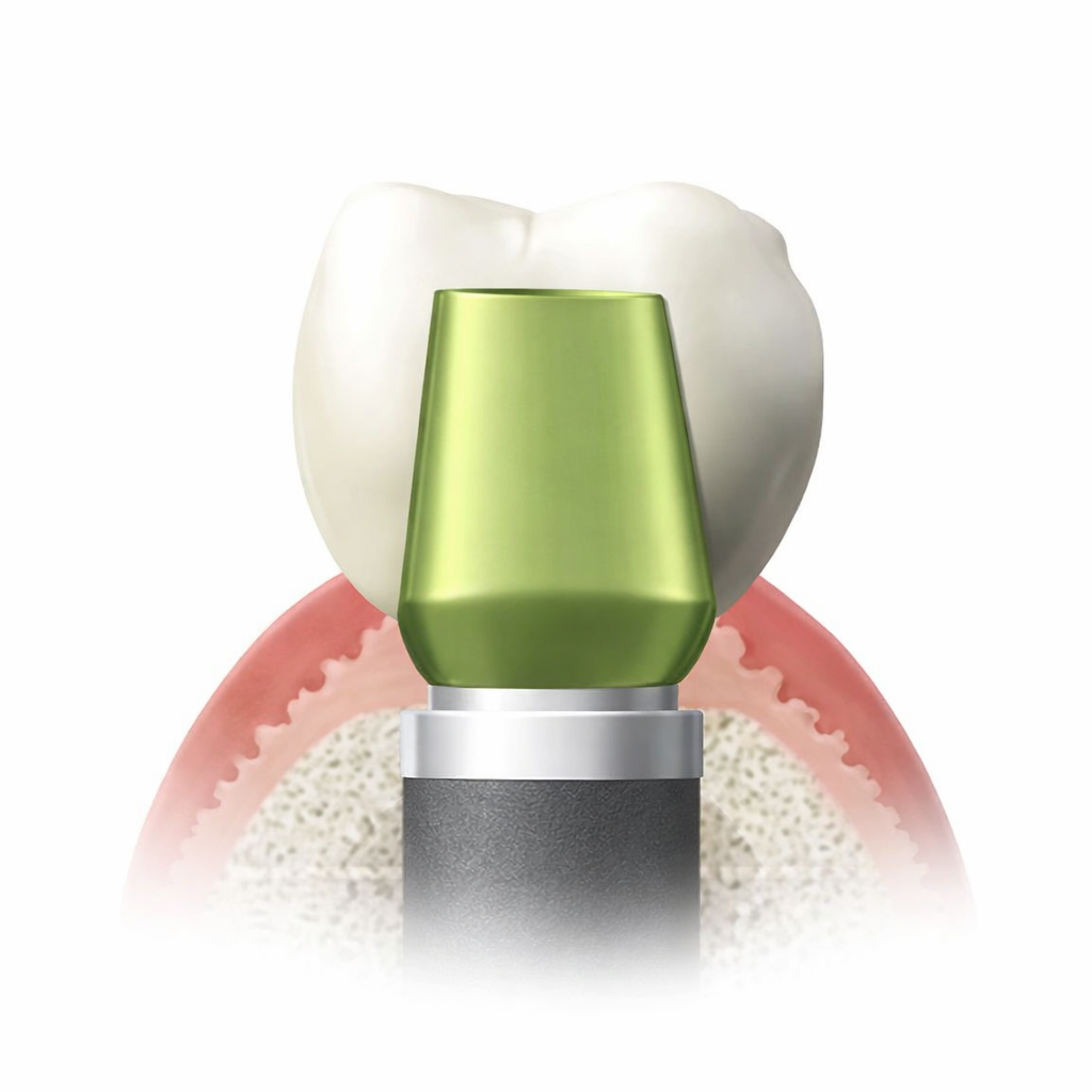 インプラントの構造図