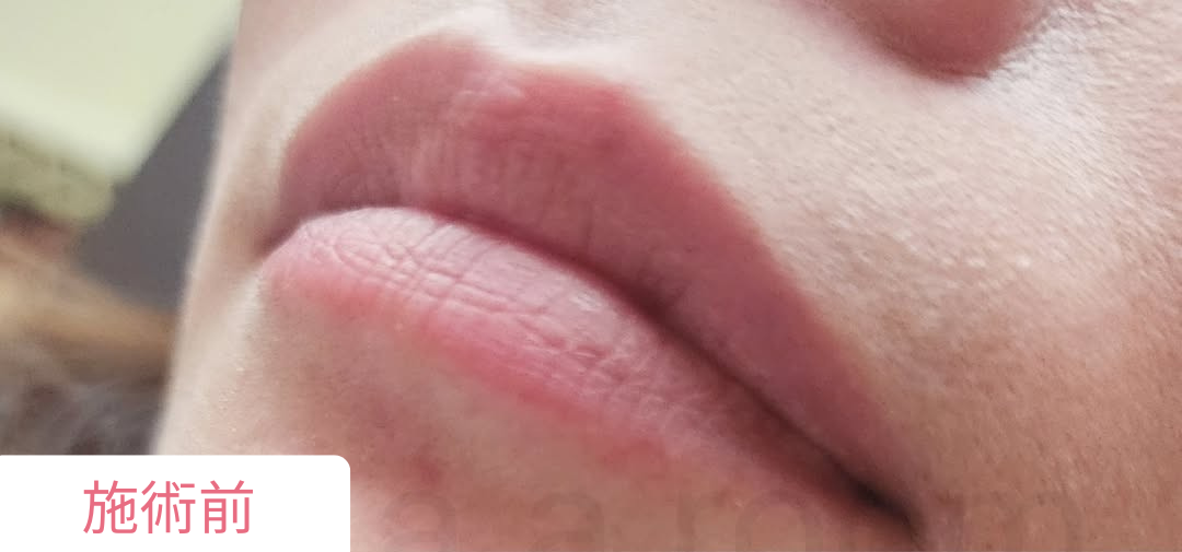 施術前