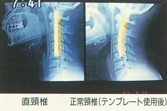 頸椎レントゲン比較(使用前・使用後)